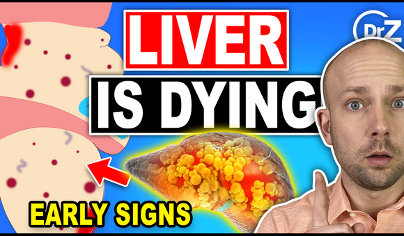 7 Unusual Signs That You Have Liver Damage - Doctor Explains