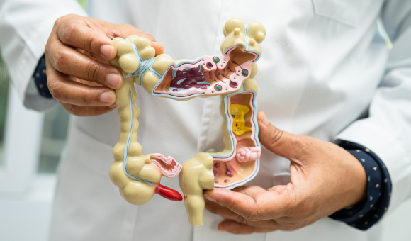 Colon Cancer Is on the Rise: How Much, Why It’s Happening, and the Hidden Role of GMOs & Pesticides