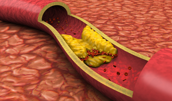 The Root Causes of High Cholesterol (It’s Not Just Saturated Fat)