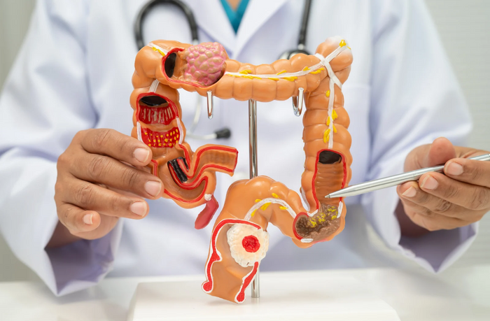 Why Colon Cancer Is Rising—and What You Can Do Now