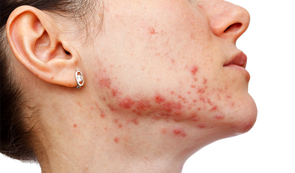 Why You Get Acne and How You Can Treat It Naturally